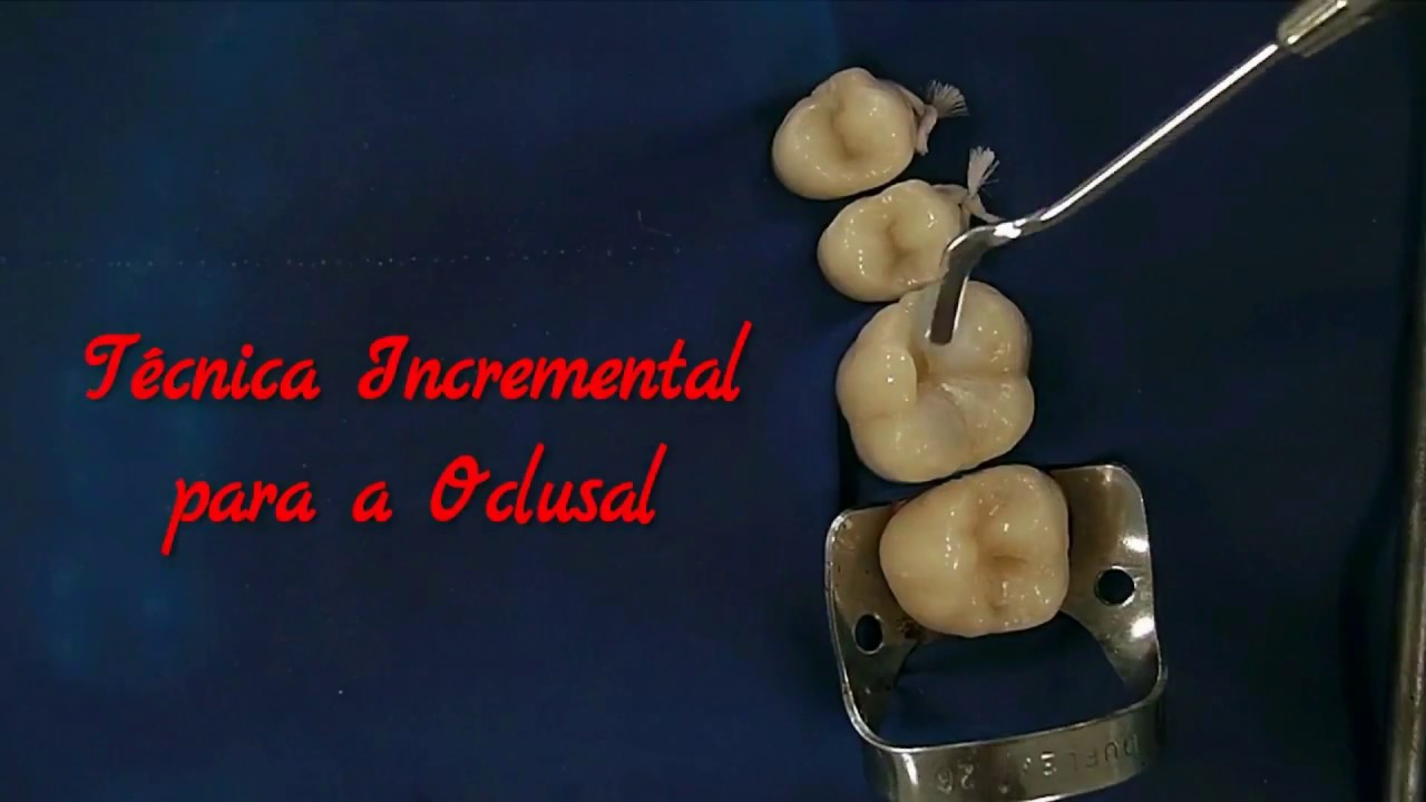 Técnica restauradora com resinas bulk fill