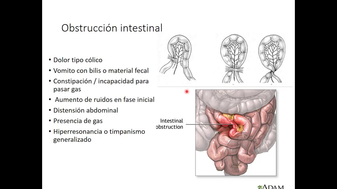 Obstrucción intestinal YouTube