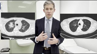 Full How Successful Is Lung Cancer Treatment — Dr. James Wilson (an Oncologist in the UK) News