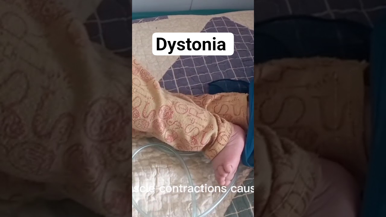 Dystonia || Developmentally delayed child