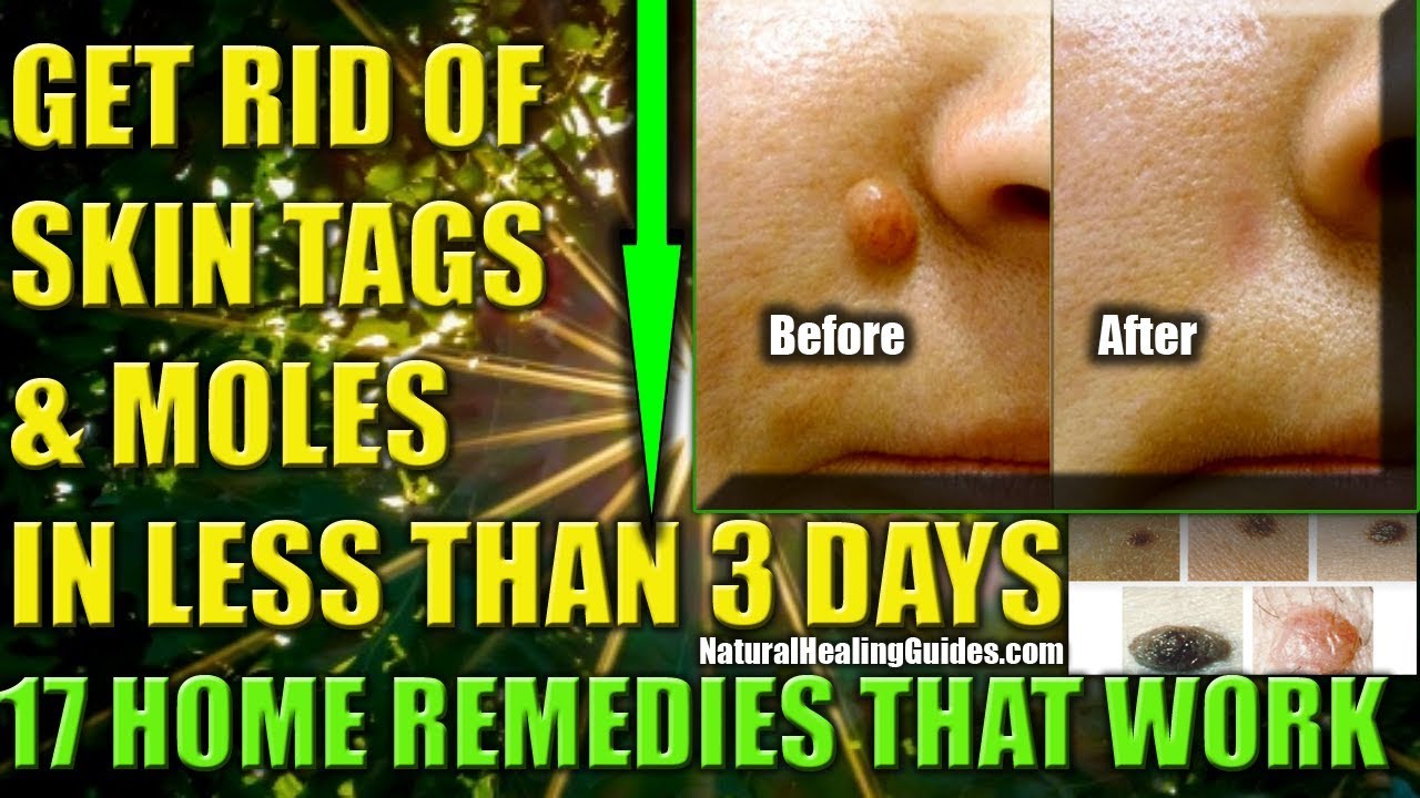 How Can I Get Rid Of Moles Aug 21 2017 · Burning The Mole Off With Apple Cider Vinegar