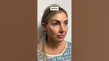 Treatment For Eye Bags That Concealer Won T Cover Dr Kami Parsa M D 