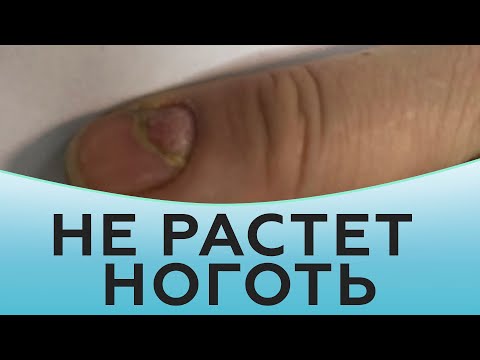 Не растет ноготь