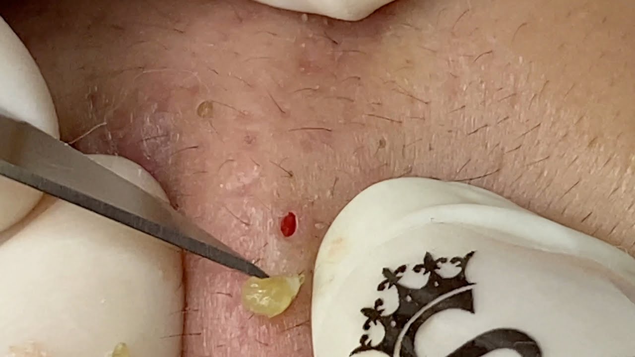 Big Deep Blackheads | Mụn Đầu Đen Siêu To - SacDepSpa#333