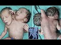 A child is born with two heads, three arms and two hearts. Look what the doctors did