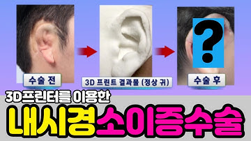 내시경 소이증수술(Microtia Surgery)