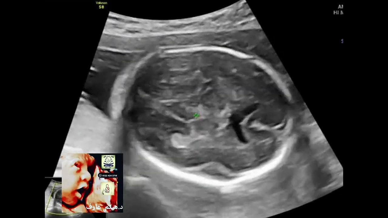 Colpocephaly Partial Agenesis Corpus Callosum Fetal Ultrasound Dr colpocephaly-partial-agenesis-corpus-callosum-fetal-ultrasound-dr