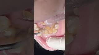 Teeth Mobility Due To Tartar And Calculus