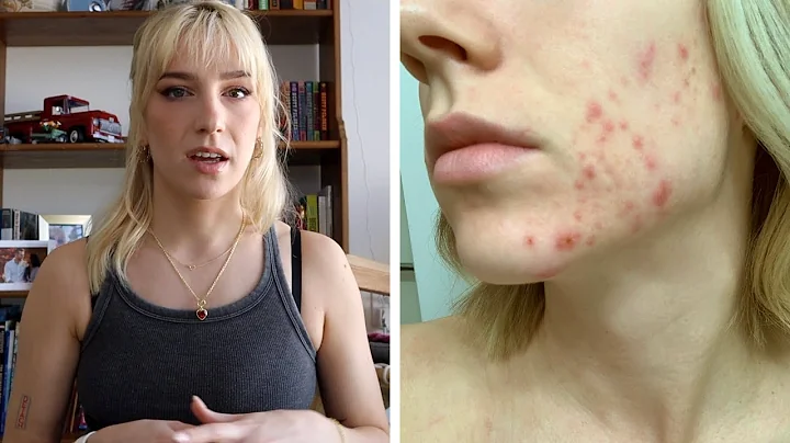 How I got rid of my acne