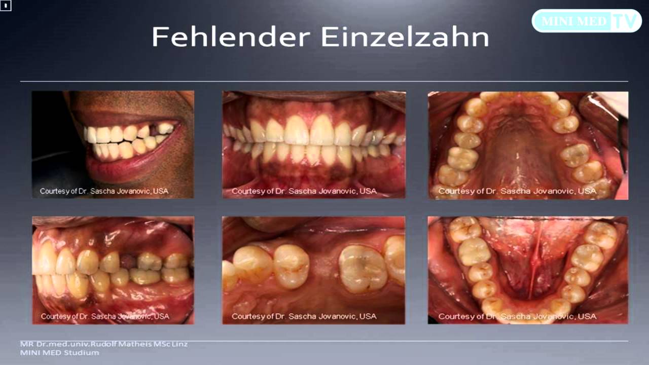 Zahnersatz implantate