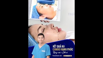 Combo Nâng mũi, cắt mí & Độn cằm_Vline ngay sau làm