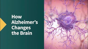 How Alzheimer