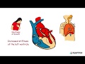 Hypertrophic cardiomyopathy  when the heart muscle becomes abnormally thick