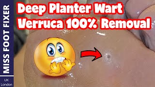 Deep Planter WART Verruca  100% Removal full Treatment By Miss Foot Fixer