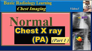 Chest X Ray, Normal Chest X Ray( PA)- Part1