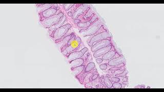 Hyperplastic Polyp - Goblet Cell Rich Variant