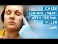 Cheek Enhancement with Dermal Filler | AAFE