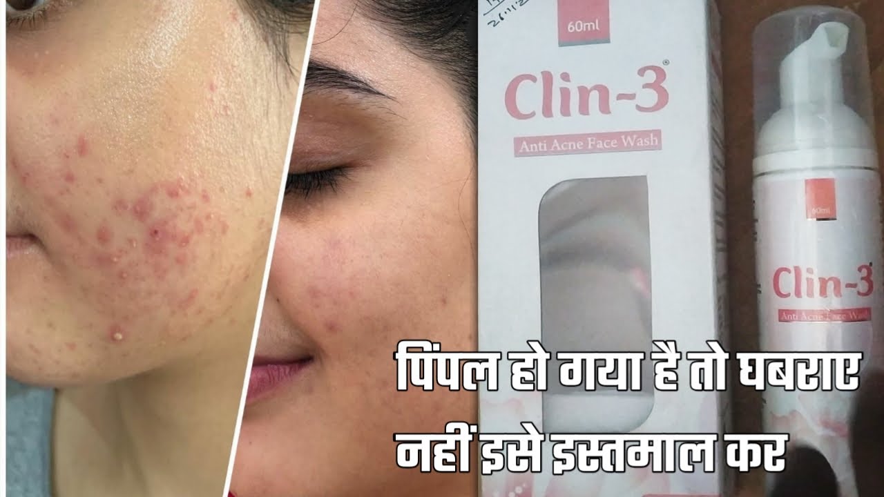 Clin 3 anti acne facewash uses in hindi clin3 face wash oily face pimple dry face skin पिंपल के