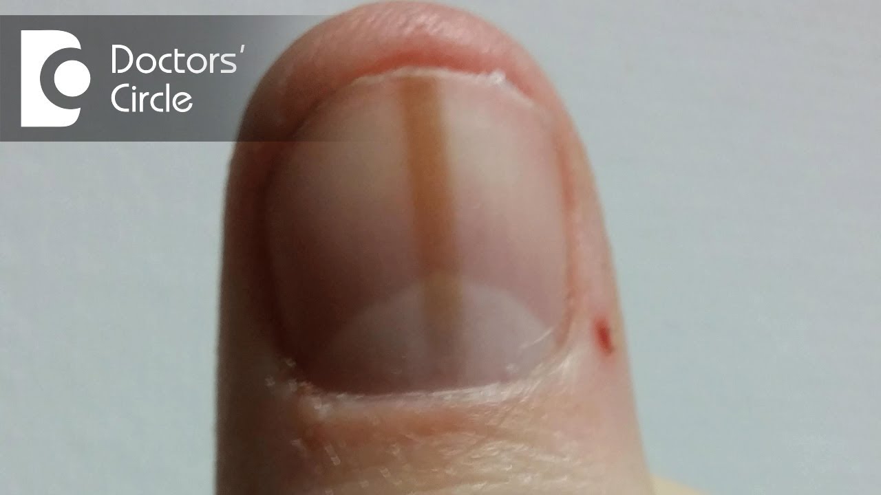 What are the causes of black lines on the nail of a baby's finger? - Quora