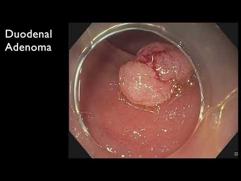 Video: Duodenal Intubation - Forberedelse, Teknik