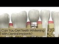 Can You Get Teeth Whitening With Dental Implants?