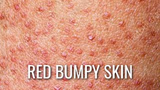 Keratosis Pilaris - How To Get Rid of Chicken Skin!