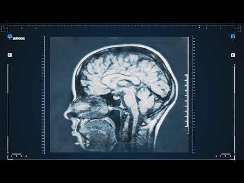המערך לנוירולוגיה - מרכז רפואי רבין