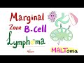 Marginal Zone B-Cell lymphoma (MALToma) | Indolent B-Cell Non-Hodgkin’s Lymphoma