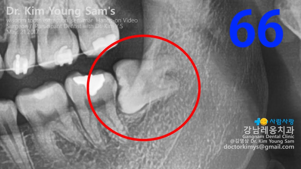 Treatment of horizontal impaction of left mandibu - 굿스마일포럼