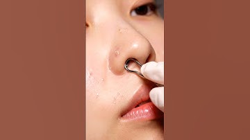 Pure Glow ASMR | Gentle Whitehead Extraction & Deep Skin Cleaning Therapy 🌿💆‍♀️😌 #cleansingsoap