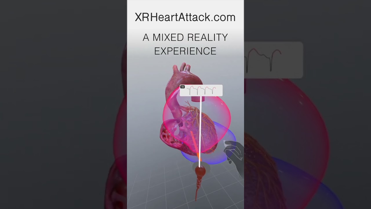 XR Heart Attack: ECG Detects Heart Attack #medicalstudent #nursingstudent #ecg #myocardialinfarction