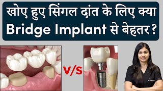 खोए हुए सिंगल दांत के लिए क्या बेहतर Bridge या Implant? | Dr. Vishakha Jain | Seraphic Dental Indore by SERAPHIC DENTAL CLINIC INDORE 843 views 2 months ago 2 minutes, 55 seconds