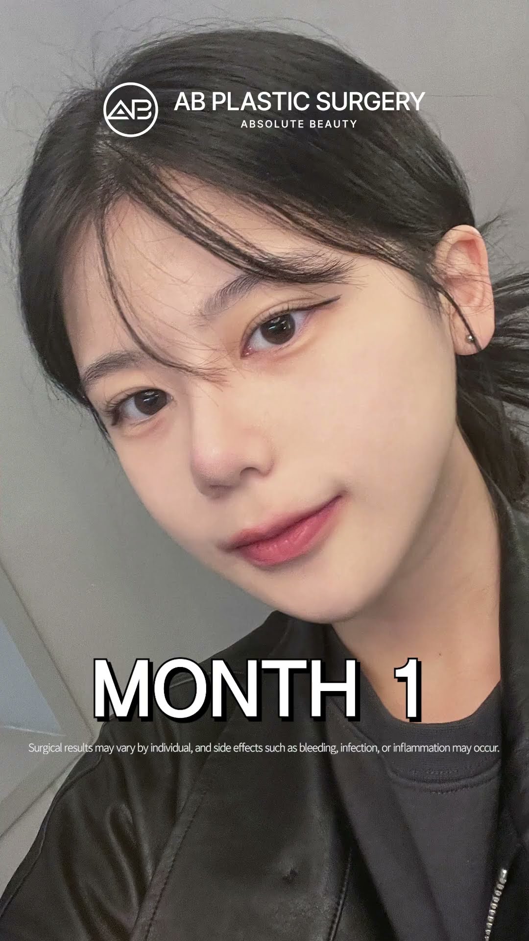 Her 1-Year Glow Up After Facial Contouring & Rhinoplasty ✨ #shorts