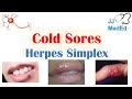 Cold Sores | Oral Herpes | Causes, Signs & Symptoms, Treatment