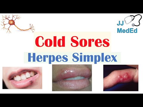 Video: Hur man berättar om du har oral herpes (med bilder)