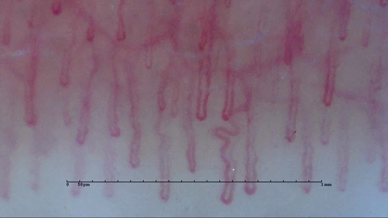 Nailfold Capillary image captured by Smart G-Scope(Woman 3)