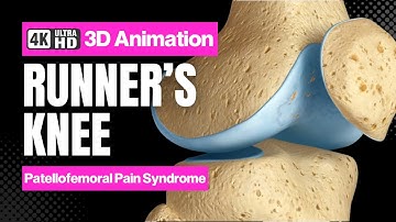 Runners Knee: Patellofemoral Pain Syndrome