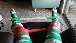 Mive Two Full Leg Cast What Should I Do Today?