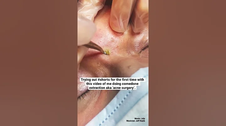 Comedone extraction #shorts