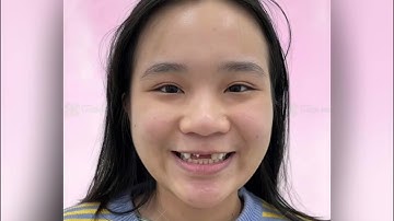 Cứu nét ngoạn mục thiết kế lại 4 răng cửa lấy lại nụ cười xinh yêu cho bạn L tại Nha khoa Thiện An