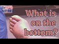 Can lymphedema go away? Toenails, Lymphedema, Athletes Foot.   [Friday Feature Replay] (2021)