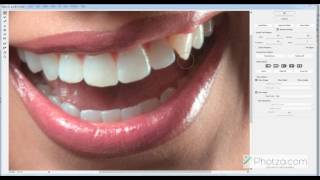 5. Tooth alignment screenshot 3