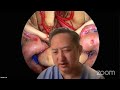 Neurosurgical tv global webcast 2nd series with james liu md august 26 2023