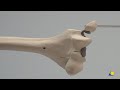 Humerus, Distal—Lateral Condyle and Medial Epicondyle Fractures