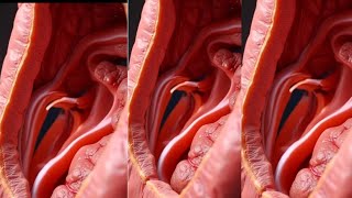 Peptic Ulcer Explained | 3D View of Stomach Lining Damage