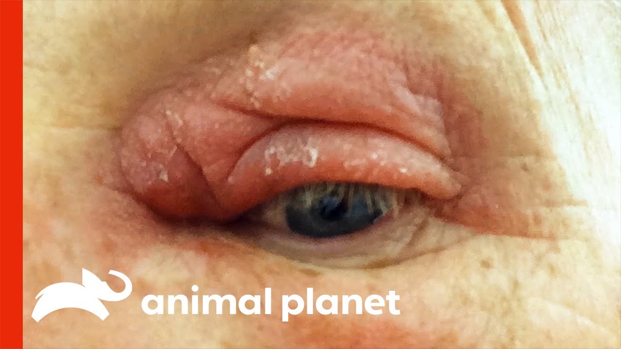 Larvae Grew Inside This Man's Eyelid