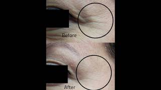 The power of Fractional CO2 Laser in treating wrinkles laser short shortsvideo shortsfeed