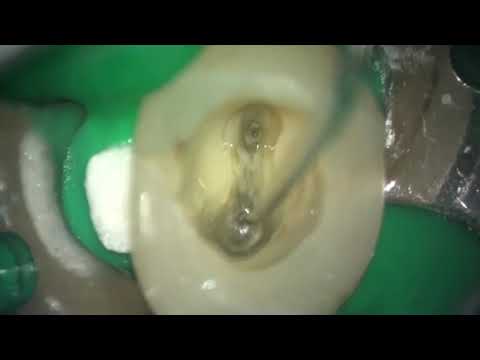 Managing sclerosed canals UR4