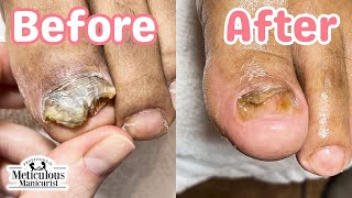 👣Tips to Treat Big Toenail Fungus at Home👣