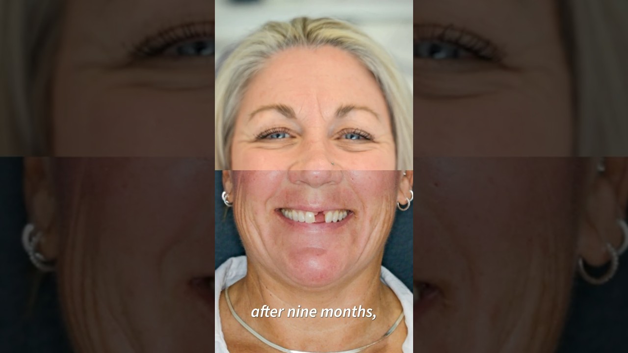 Front Tooth Dental Crown Before & After